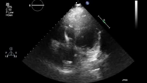 Ultraschall Transesophageale Untersuchung Des Herzens — Stockvideo