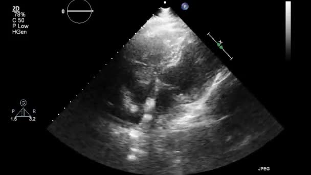 Ultraschall Transesophageale Untersuchung Des Herzens — Stockvideo