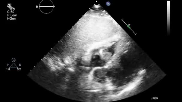 Echografie Transslokdarmonderzoek Van Het Hart — Stockvideo