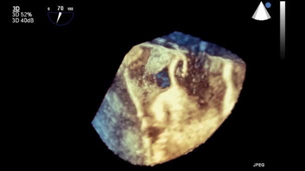 Echografie Transslokdarmonderzoek Van Het Hart — Stockvideo