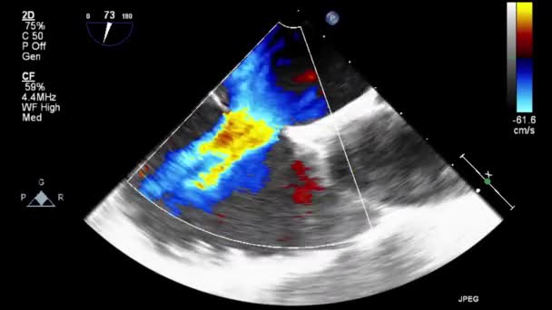 Usg Przełyku Przełyku Serca — Wideo stockowe