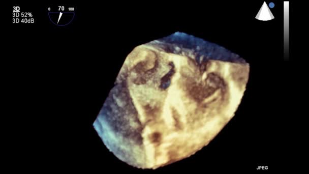 Ultrasound Transesophageal Examination Heart — Stock Video