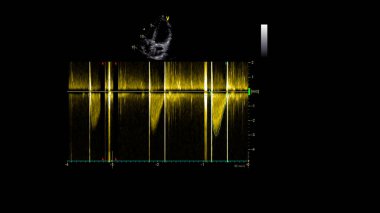 Transesofageal ultrason sırasında kalbin gri ölçekli görüntüsü.