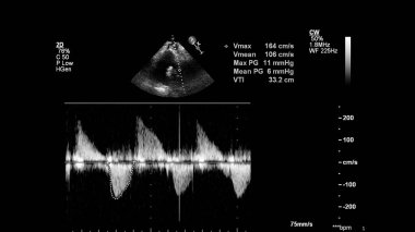 Transesofageal ultrason sırasında kalbin gri ölçekli görüntüsü.