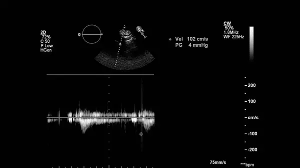 Transesofageal Ultrason Sırasında Kalbin Gri Ölçekli Görüntüsü — Stok fotoğraf