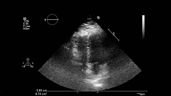 Изображение сердца в сером режиме во время трансофагеального ультразвука.