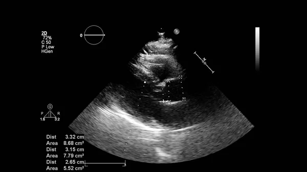 Transesofageal Ultrason Sırasında Kalbin Gri Ölçekli Görüntüsü — Stok fotoğraf