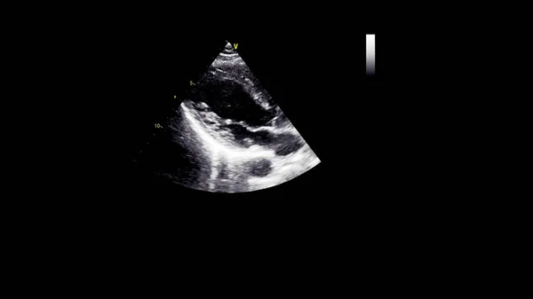 Imagem Coração Escala Cinza Durante Ultrassonografia Transesofágica — Fotografia de Stock