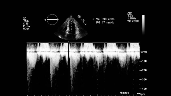 经食管超声下灰度型心脏影像学 — 图库照片