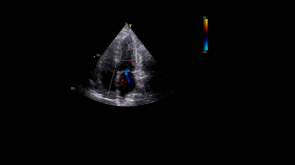 Imagem Coração Durante Ultrassom Transesofágico Com Modo Doppler — Fotografia de Stock