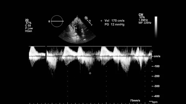 Transesofageal Ultrason Sırasında Kalbin Gri Ölçekli Görüntüsü — Stok fotoğraf