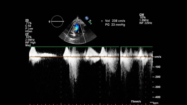 Afbeelding Van Het Hart Grijs Schaal Modus Tijdens Transesofageale Echografie — Stockfoto