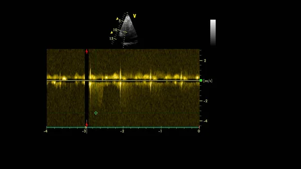 Image Cœur Mode Gris Lors Une Échographie Transœsophagienne — Photo