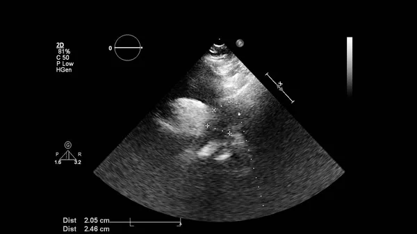 Изображение Сердца Сером Режиме Время Трансофагеального Ультразвука — стоковое фото