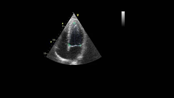 Image of the heart in gray-scale mode during transesophageal ultrasound.