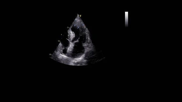 Image of the heart in gray-scale mode during transesophageal ultrasound.