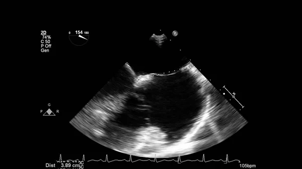 经食管超声下灰度型心脏影像学 — 图库照片