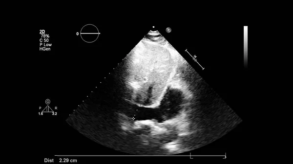 Изображение Сердца Сером Режиме Время Трансофагеального Ультразвука — стоковое фото