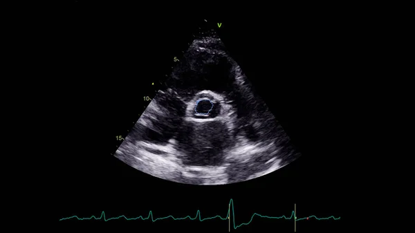 Image Heart Gray Scale Mode Transesophageal Ultrasound — Stock Photo, Image