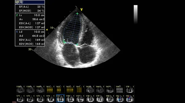 Transesofageal Ultrason Sırasında Kalbin Gri Ölçekli Görüntüsü — Stok fotoğraf