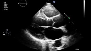 Kalbin ultrason transsofageal muayenesi.