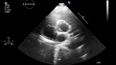 Kalbin ultrason transsofageal muayenesi.