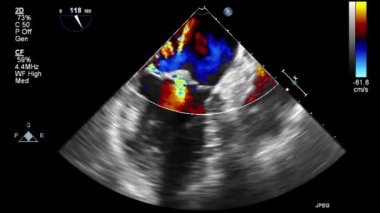 Kalbin ultrason transsofageal muayenesi.