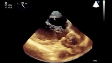 Kalbin ultrason transsofageal muayenesi.