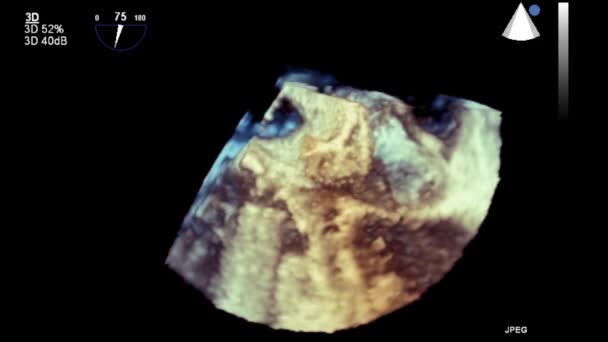 Ultrasound Transesophageal Examination Heart — Stock Video