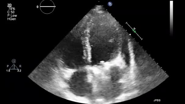 Ultraschall Transesophageale Untersuchung Des Herzens — Stockvideo