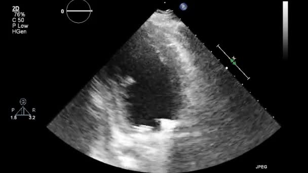 Ultraljudstransesofageal Undersökning Hjärtat — Stockvideo