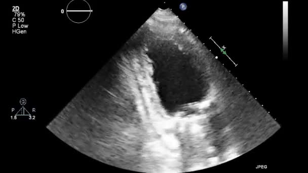 Ultraljudstransesofageal Undersökning Hjärtat — Stockvideo