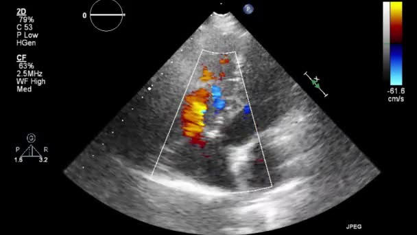Ultrazvukové Transesofageální Vyšetření Srdce — Stock video