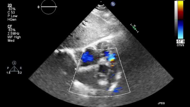 Exame Transesofágico Ultrassonográfico Coração — Vídeo de Stock