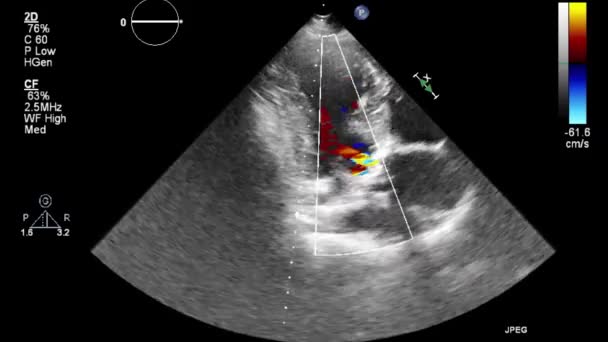 Ultrasound Transesophageal Examination Heart — Stock Video