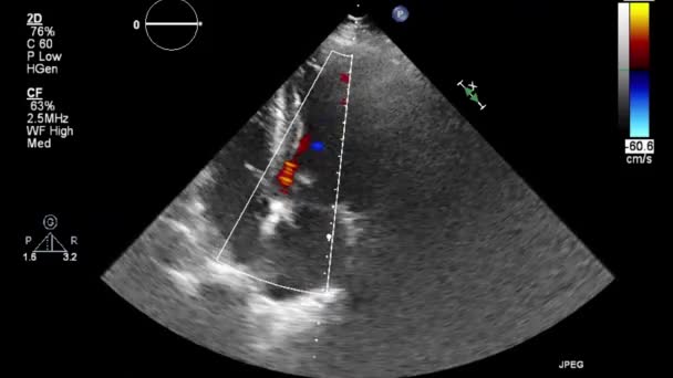 Ultrasound Transesophageal Examination Heart — Stock Video