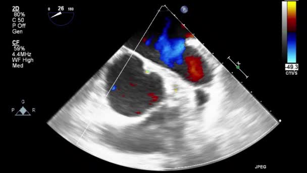 Ультразвуковое Трансофагеальное Исследование Сердца — стоковое видео