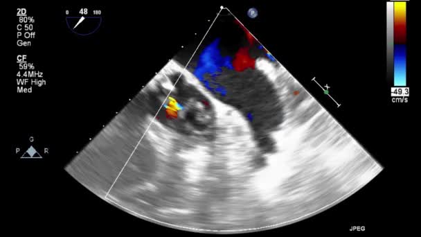 Ультразвуковое Трансофагеальное Исследование Сердца — стоковое видео