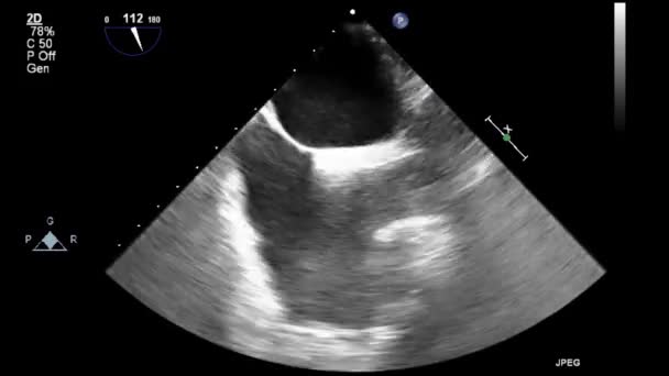 Kalbin Ultrason Transsofageal Muayenesi — Stok video