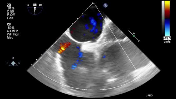 Ultraschall Transesophageale Untersuchung Des Herzens — Stockvideo