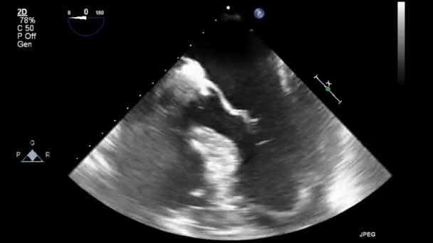 超声经食管检查心脏 — 图库视频影像