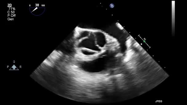 Exame Transesofágico Ultrassonográfico Coração — Vídeo de Stock