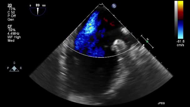 Ultrasound Transesophageal Examination Heart — Stock Video