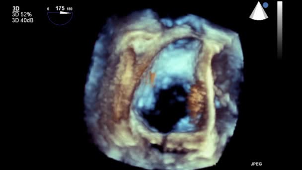 Echografie Transslokdarmonderzoek Van Het Hart — Stockvideo