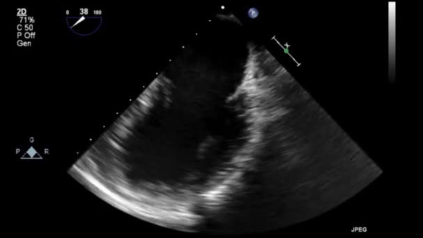 Ecografia Esame Transesofageo Del Cuore — Video Stock