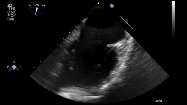 Echografie Transslokdarmonderzoek Van Het Hart — Stockvideo