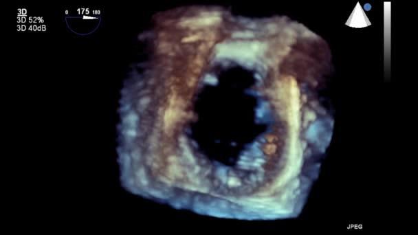 Exame Transesofágico Ultrassonográfico Coração — Vídeo de Stock