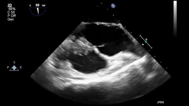 Ecografia Esame Transesofageo Del Cuore — Video Stock