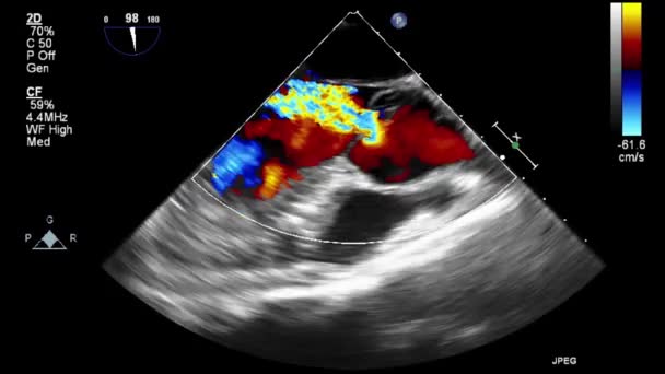 Ecografia Esame Transesofageo Del Cuore — Video Stock