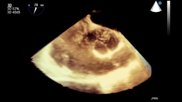 Ultrasound Transesophageal Pemeriksaan Jantung — Stok Video